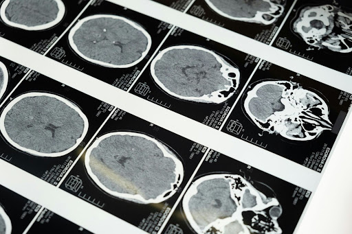 Depo-Provera brain tumor claim