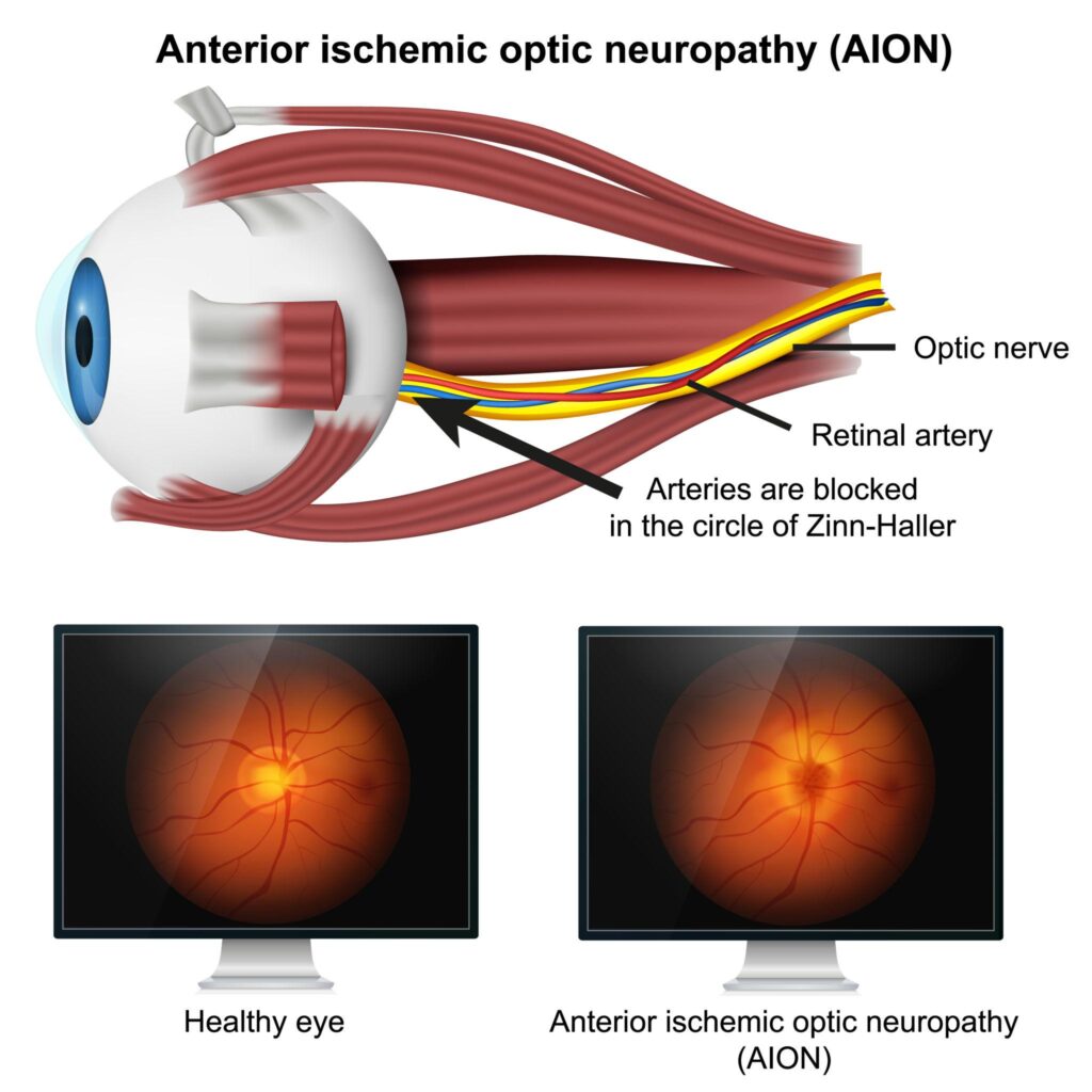 Ozempic vision loss claim